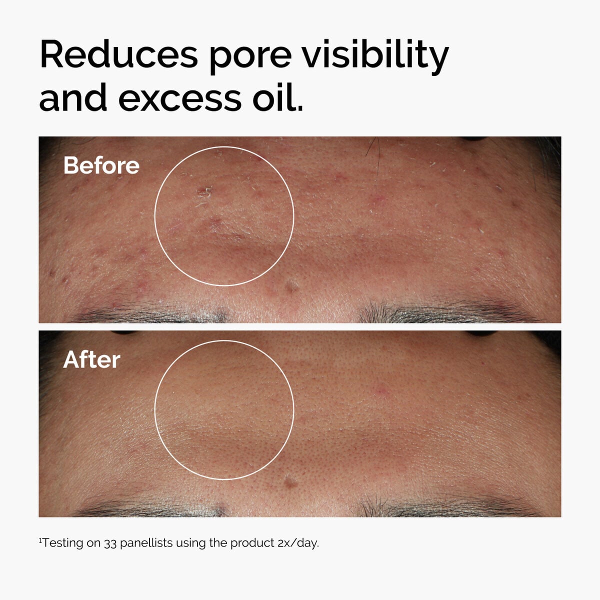 niacinamide-10-zinc-1-q4 ord-niacinamide-zinc-blemish-serum-before-after-pores.jpg