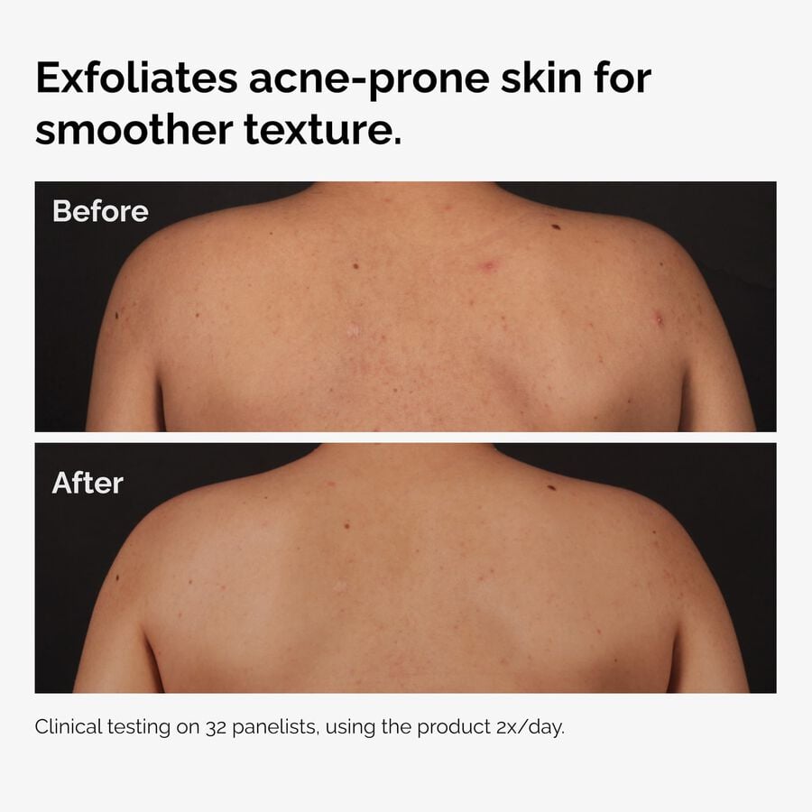 the-body-care-collection-t3 ord-salicylic-acid-body-serum-before-after-graphic-NA.jpg