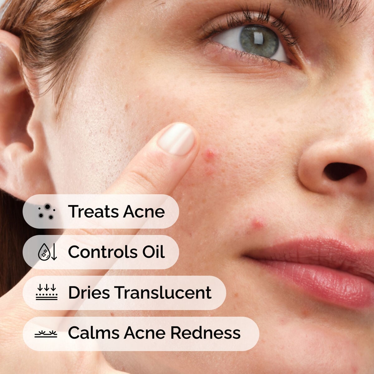 sulfur-10-powder-to-cream-concentrate-j2 ord-sulfur-10pct-powder-to-cream-concentrate-model-application-with-benefits-acne.jpg