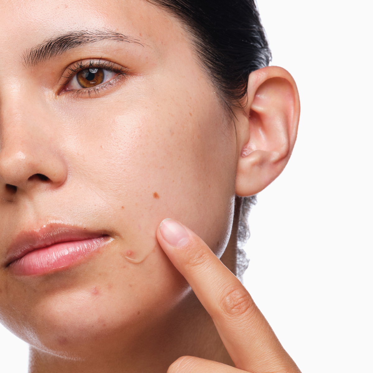 the-acne-set-e9 rdn-the-acne-set-application.png